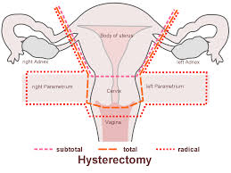 When can i have sex after hysterectomy?